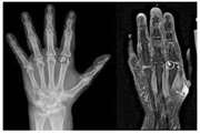 Detection of bone erosion in early rheumatoid arthritis: ultrasonography and conventional radiography versus non-contrast magnetic resonance imaging