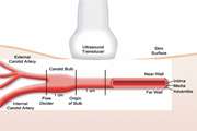 The sonographic findings of subclinical atherosclerosis in common carotid arteries: Rheumatoid arthritis patients Versus control group