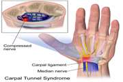 Color and power Doppler US for diagnosing carpal tunnel syndrome and determining its severity: a quantitative image processing method