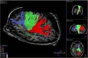 Improvement of White Matter Fiber Tracking Based on Diffusion-Tensor MR Imaging Data Using Modified Speed Functions