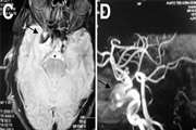 Uncommon Patterns of Intracranial Aneurysms: A Pictorial Essay