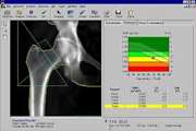 Correlation between bone mineral densitometry and liver/heart iron overload evaluated by quantitative T2* MRI