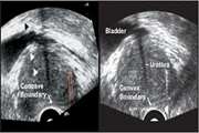 Decrease in infection rate following use of povidone-iodine during transrectal ultrasound guided biopsy of the prostate: a double blind randomized clinical trial