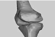 Reliability of determination of bony landmarks of the distal femur on mr images and mri-based 3d models