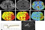  بررسی حساسیت و اختصاصیت MRI پرفیوژن در درج بندی تومورهای گلیال مغز 