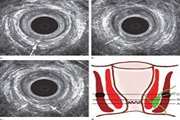 Evaluation of hydrogen peroxide- enhanced endoanal ultrasound in detecting the internal orifice and type of fistula-in-ano