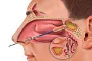 Correlation of Lund-Mackay and SNOT-20 Before and After Functional Endoscopic Sinus Surgery (FESS): Does the Baseline Data Predict the Response Rate?