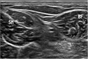 Test-retest reliability of nerve and muscle morphometric characteristics utilizing ultrasound imaging in individuals with unilateral sciatica and controls