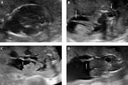 Neural Tube Defects: Distribution and Associated Anomalies Diagnosed by Prenatal Ultrasonography in Iranian Fetuses