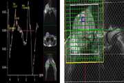 Weighted Imaging and Proton Magnetic Resonance Spectroscopy Findings in Osteosarcoma Versus Normal Muscle