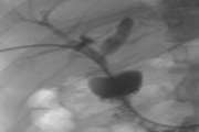 Short- and Long-Term Outcome of Balloon Dilatation of Benign Biliary Strictures