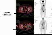 Endometrial metastasis from ductal breast carcinoma: A case report with literature review