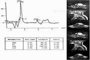 3T magnetic resonance spectroscopy as a powerful diagnostic modality for assessment of thyroid nodules