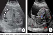 A case of fetal sacrococcygeal teratoma: a comparison between ultrasonography and magnetic resonance imaging findings