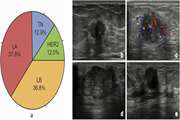 Sonographic Features of Estrogen-Negative Breast Cancers: A Correlation Study With Human Epidermal Growth Factor Type II Overexpression