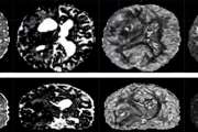 Differentiation of edematous, tumoral and normal areas of brain using diffusion tensor and neurite orientation dispersion and density imaging