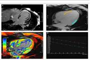 Correlations of T2* Mapping with delayed gadolinium enhancement in magnetic resonance imaging of chronic myocardial infarction