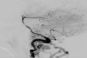 Loud, non-stethoscope audible pulsatile tinnitus and papilledema: A rare presentation of dural arteriovenous fistula