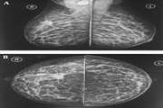 Pregnancy-associated Breast Cancer: A Review of Imaging Modalities