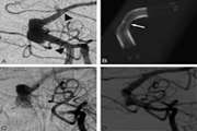 Mid-Term Outcome Following Pipeline Embolization of Unruptured Intracranial Aneurysms