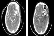 The Diagnostic Value of CT Angiography in the Diagnosis of Residual Aneurysm After Brain Aneurysm Surgery