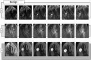 Spatiotemporal features of DCE-MRI for breast cancer diagnosis