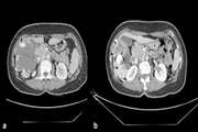 Percutaneous Sclerotherapy for Giant Symptomatic Liver Hemangiomas: A Pilot Study