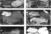 ADC-derived spatial features can accurately classify adnexal lesions