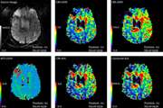 Diagnostic Efficacy of Perfusion Magnetic Resonance Imaging in Supratentorial Glioma Grading