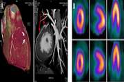 Diagnostic Ability of 384-Slice Computed Tomographic Angiography in Prediction of Myocardial Ischemia in Patients with Myocardial Bridging (MB) as Compared to SPECT-MPI Examination