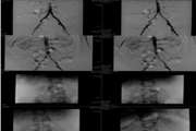 Corrigendum: Peripheral venous malformations with a dominant outflow vein: Results of ethanol embolization (Acta Medica Iranica, (2014)52, 11, 868-871)