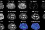 Characterization of Active and Infiltrative Tumorous Subregions From Normal Tissue in Brain Gliomas Using Multiparametric MRI