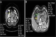 Pancreatic neuroendocrine tumors (pNETs): the predictive value of MDCT characteristics in the differentiation of histopathological grades( Articles not published yet, but available online Article in press About articles in press (opens in a new window) )