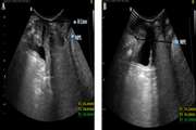 Agreement of Ultrasound Measures with POP-Q in Patients with Pelvic Organ Prolapse