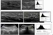 Neuromuscular morphometric characteristics in low back pain with unilateral radiculopathy caused by disc herniation: An ultrasound imaging evaluation