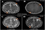 A 41-year-old female with progressive multifocal leukoencephalopathy after liver transplant