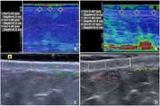 Sonoelastography for skin evaluation in sclerodermic patients