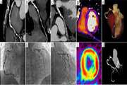 Coronary CT Angiography and Dual-Energy Computed Tomography in Ischemic Heart Disease Suspected Patients