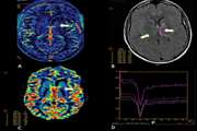 بررسی یافته های سونوگرافی و( DYNAMIC CONTRAST ENHANCED MRI (DCE MR در بیماران مبتلا به مول مهاجم و کوریوکارسینوم