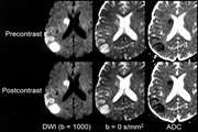 بررسی دقت تشخیصی Diffusion-weighted imaging(DWI) و apparent diffusion coefficient (ADC) value  جهت تعیین بدخیمی توده های آدنکسال مراجعه کننده به بخش جراحی زنان بیمارستان ولیعصر (عج) در سال 1393