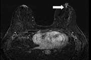 الگوها  و نتایج non-mass enhancement  در MRI پستان و تطابق با نتایج پاتولوژی