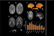 مقایسه یافته های Fetal brain MRI در جنین های    IUGR در دو گروه Clinically significant و Clinically non-significant