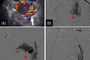 Fertility outcomes after uterine artery embolization for symptomatic uterine arteriovenous malformations: a single-center retrospective study in 33 women