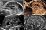 Fetal corpus callosum abnormalities: Ultrasound and magnetic resonance imaging role