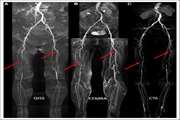 Gadolinium Enhanced MR-angiography Results in Patients With Peripheral Arterial Disease: Positive Predictive Value Compared to Surgery