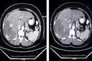 Management of Liver Hemangioma Using Trans-Catheter Arterial Embolization