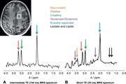 بررسی ارزش تشخیصی (Magnetic resonance Spectroscopy)MRS در شناسایی  توده های خوش خیم و بدخیم غدد بزاقی در مقایسه با نتایج حاصله از  بیوپسی