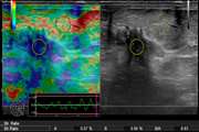 Diagnostic Performance of Sonoelastography in Addition to Ultrasound in Investigating Breast Lesions: Can Concomitant Use of These Techniques Lead to Improvement of Differentiation