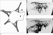 Peripheral Venous Malformations with a Dominant Outflow Vein: Results of Ethanol Embolization 