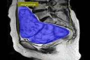 Segmentation of uterine using neighborhood information affected possibilistic fcm and gaussian mixture model in uterine fibroid patients MRI